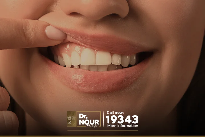 علاج اللثة