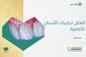أفضل تركيبات الأسنان الأمامية جدة