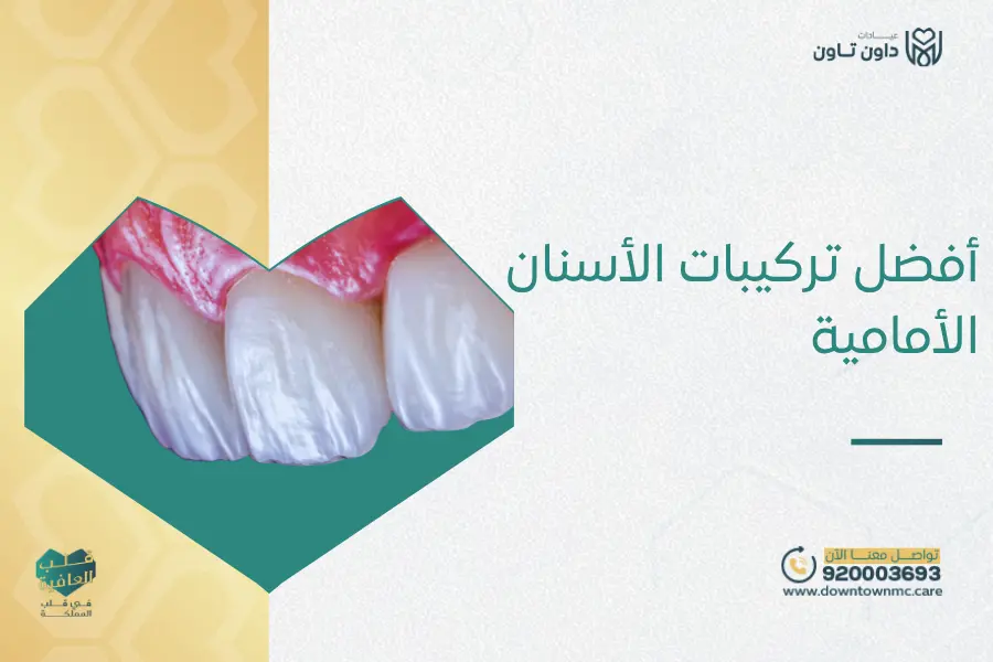 أفضل تركيبات الأسنان الأمامية جدة