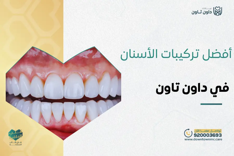 أفضل تركيبات الأسنان في داون تاون