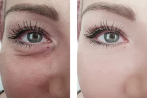 إبرة السلمون للوجه قبل وبعد