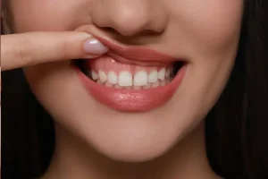 الابتسامة اللثوية قبل وبعد 