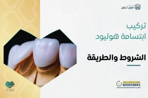 تركيب ابتسامة هوليود