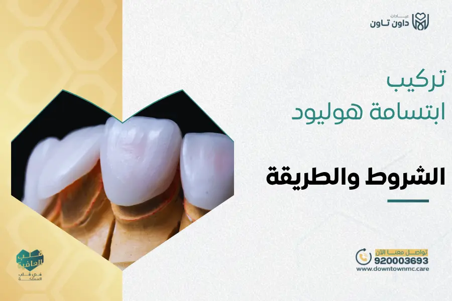 تركيب ابتسامة هوليود