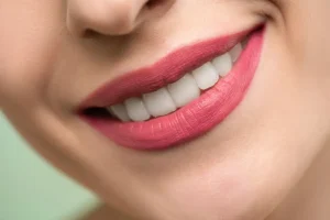 تركيب سناب اون سمايل Snap on Smile