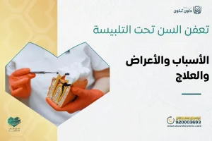 تعفن السن تحت التلبيسة: الأسباب والأعراض وطرق العلاج