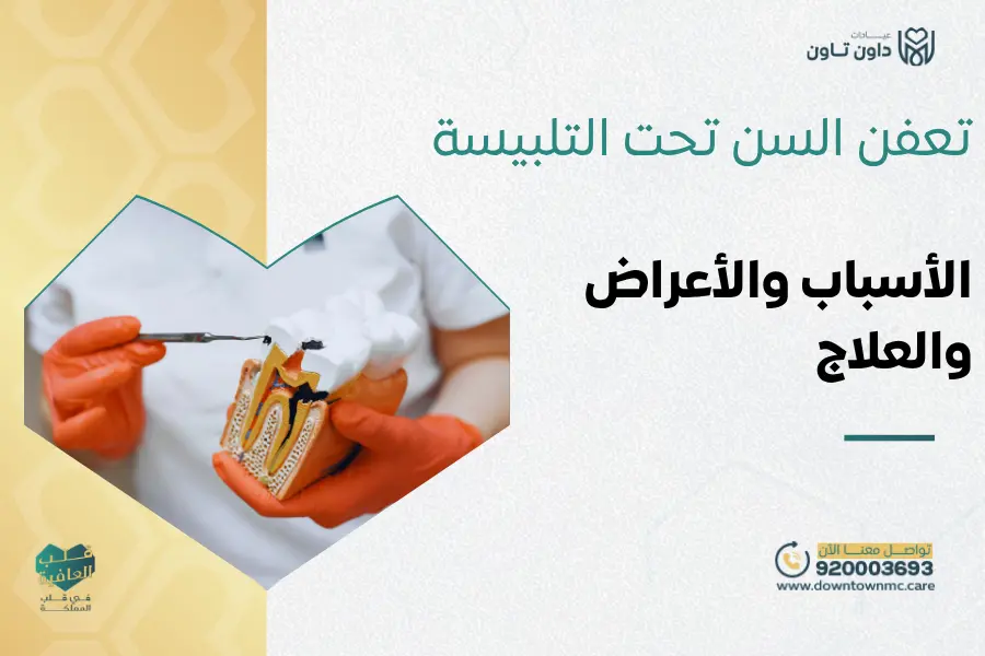 تعفن السن تحت التلبيسة: الأسباب والأعراض وطرق العلاج