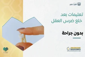 تعليمات بعد خلع ضرس العقل بدون جراحة