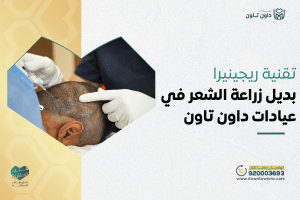 تقنية ريجينيرا بديل زراعة الشعر في عيادات داون تاون