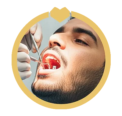 زراعة الأسنان