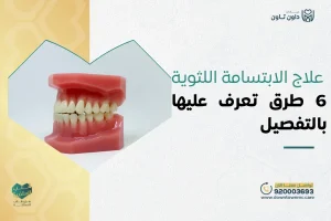 علاج الابتسامة اللثوية