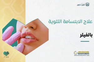 علاج الابتسامة اللثوية بالفيلر