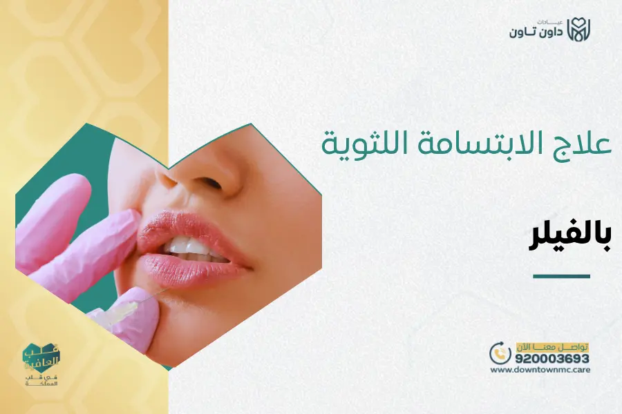 علاج الابتسامة اللثوية بالفيلر