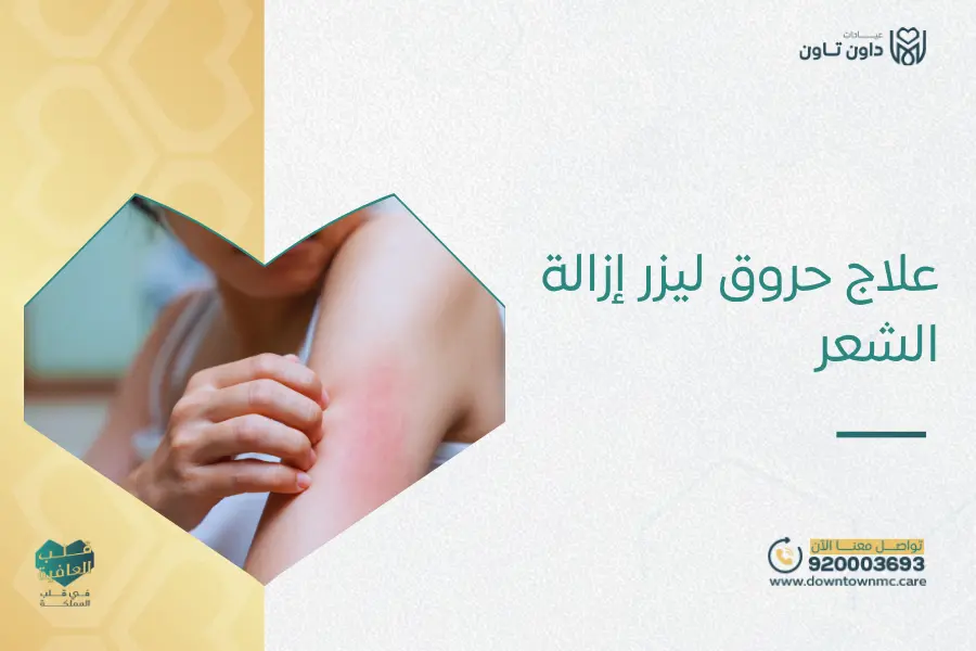علاج حروق ليزر إزالة الشعر