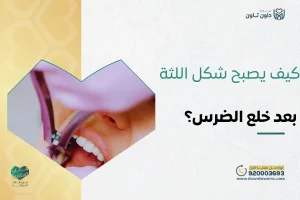 كيف يصبح شكل اللثة بعد خلع الضرس؟