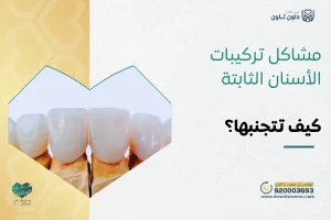 مشاكل تركيبات الأسنان الثابتة