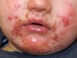 impetigo القوباء