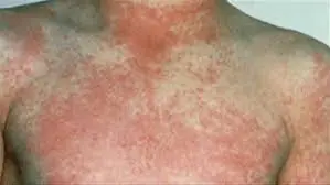 الحمى القرمزية