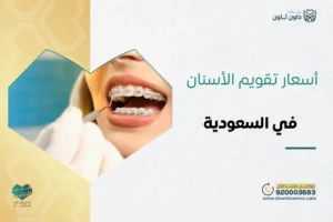 أسعار تقويم الأسنان السعودية