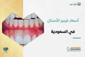 أسعار فينير الأسنان في السعودية