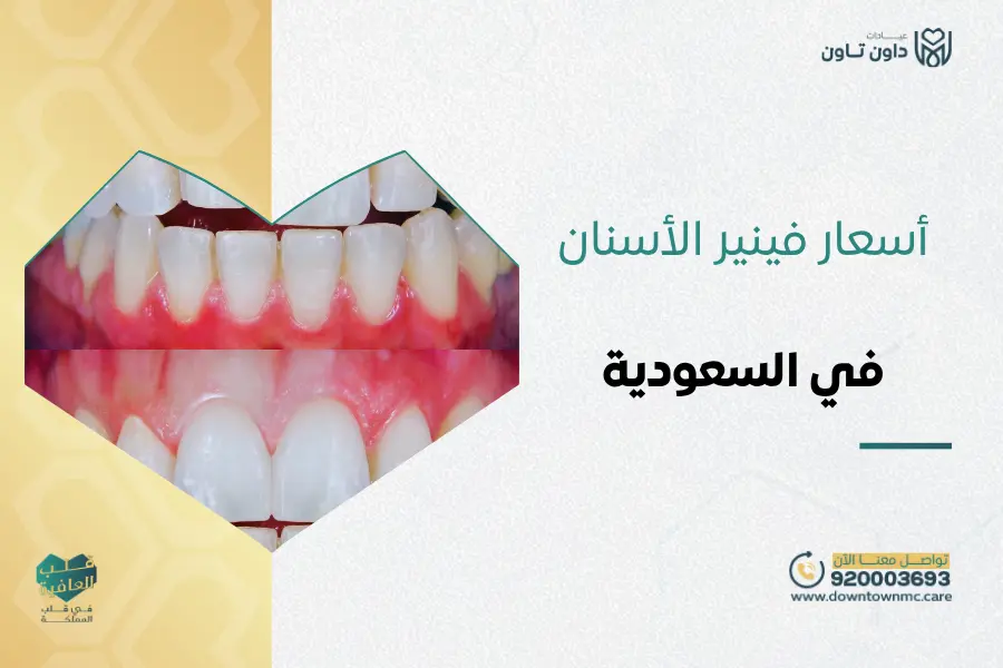 أسعار فينير الأسنان في السعودية