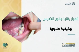 أضرار بقايا جذور الضرس وكيفية علاجها