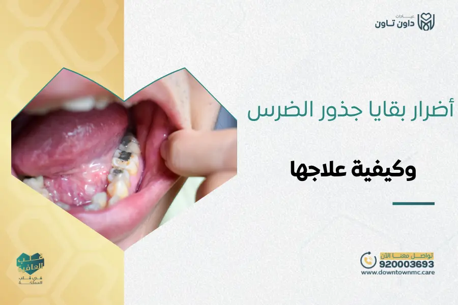أضرار بقايا جذور الضرس
