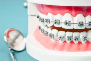 أضرار تقويم الأسنان على اللثة