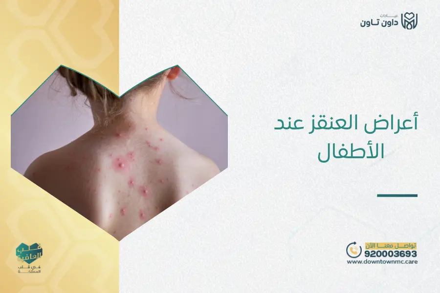 أعراض العنقز عند الأطفال