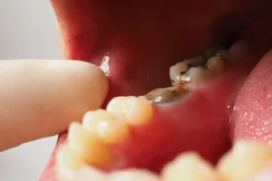 أعراض بقايا الضرس المخلوع وجذور السن في اللثة 