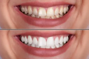 الابتسامة اللثوية قبل وبعد 