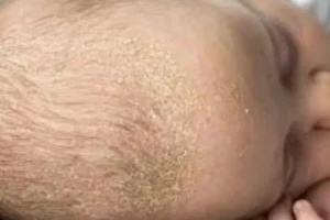 التهاب الجلد الدهني