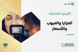 الفينير المتحرك: المزايا والعيوب والأسعار