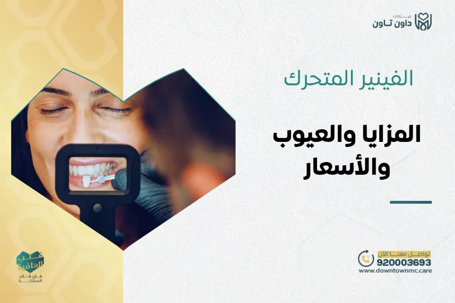 الفينير المتحرك: المزايا والعيوب والأسعار
