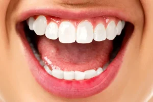 الفينير ورائحة الفم