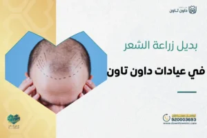 بديل زراعة الشعر في عيادات داون تاون