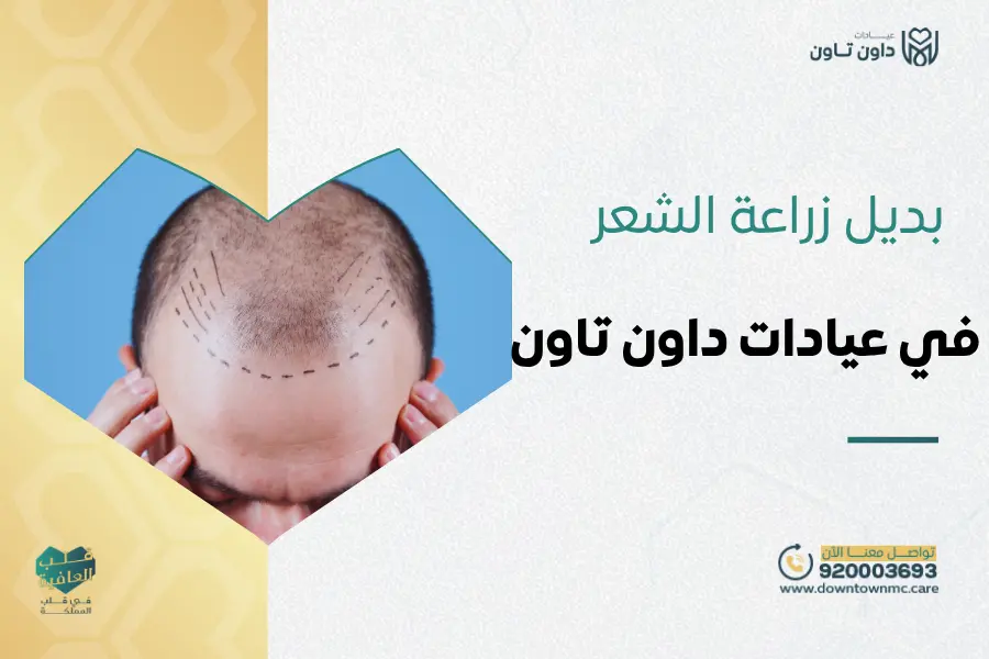 بديل زراعة الشعر في عيادات داون تاون