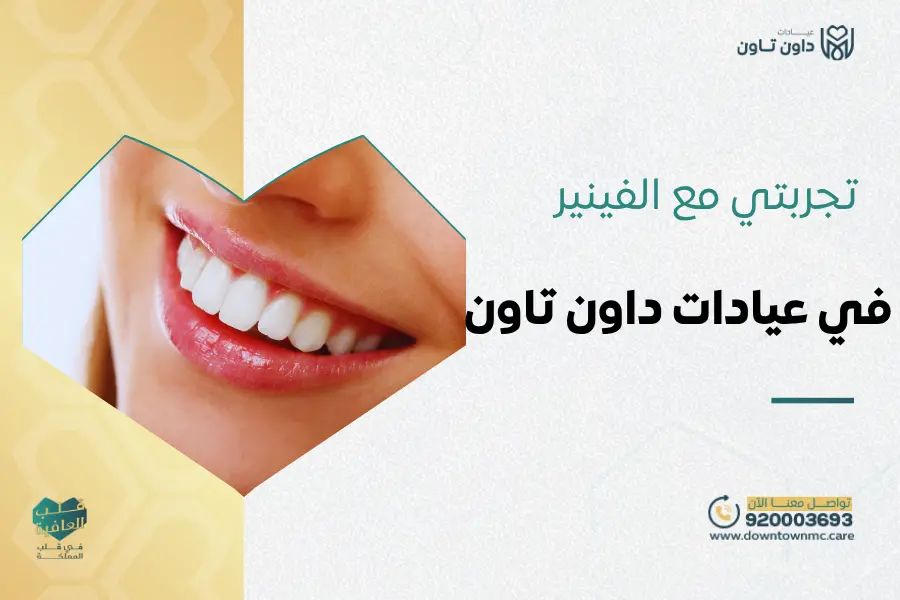 تجربتي مع الفينير في عيادات داون تاون