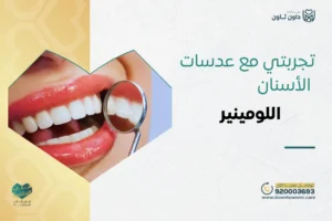تجربتي مع عدسات الأسنان اللومينير