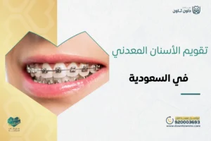 تقويم الأسنان المعدني في السعودية