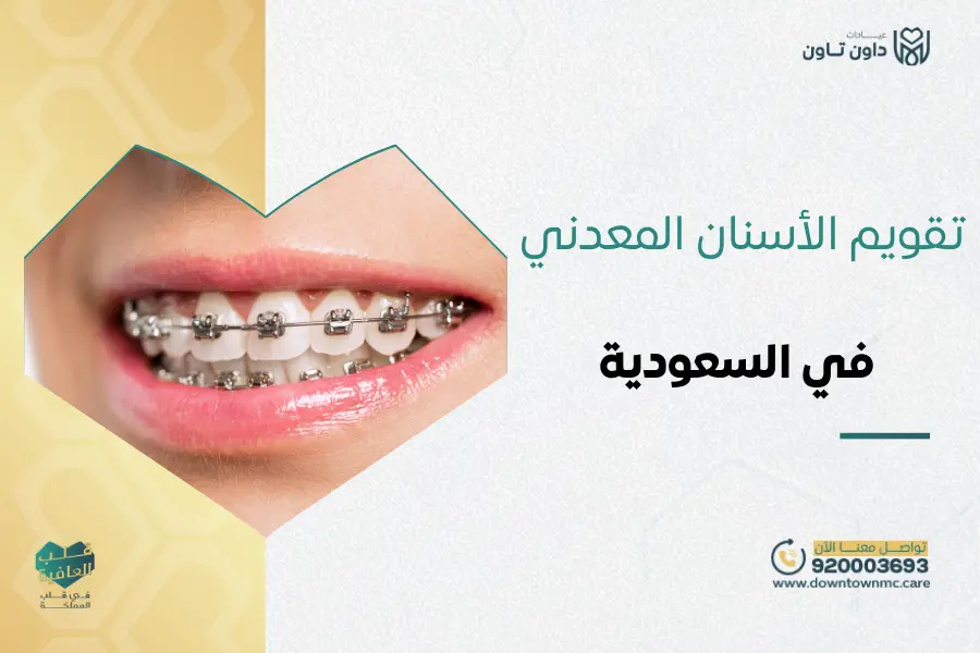 تقويم الأسنان المعدني في السعودية