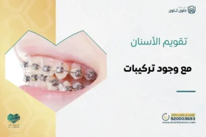 تقويم الأسنان مع وجود تركيبات