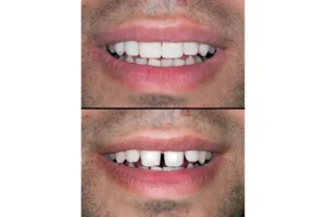 تقويم انفزلاين قبل وبعد