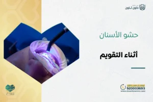 حشو الأسنان أثناء التقويم