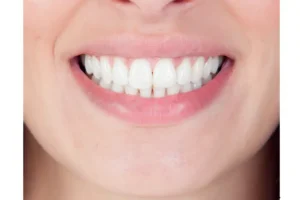خطوات تجربتي مع عدسات الأسنان اللومينير