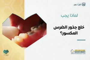 خلع جذور الضرس المكسور