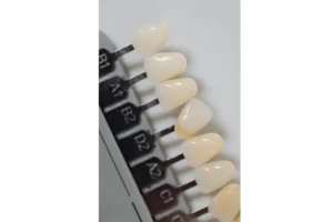 درجات ألوان أسنان الفينير و كيف تختار درجة بياض الفينير المناسبة لأسنانك؟