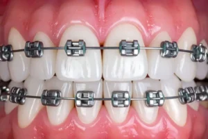 شكل تقويم الأسنان المعدني