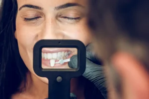 طريقة تركيب الفينير المتحرك