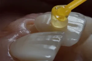 طريقة تنظيف عدسات الأسنان